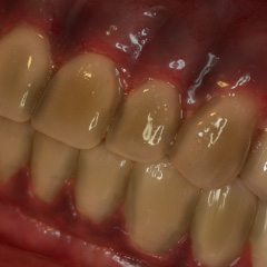 黒ずんだ歯茎と黄ばんだ歯